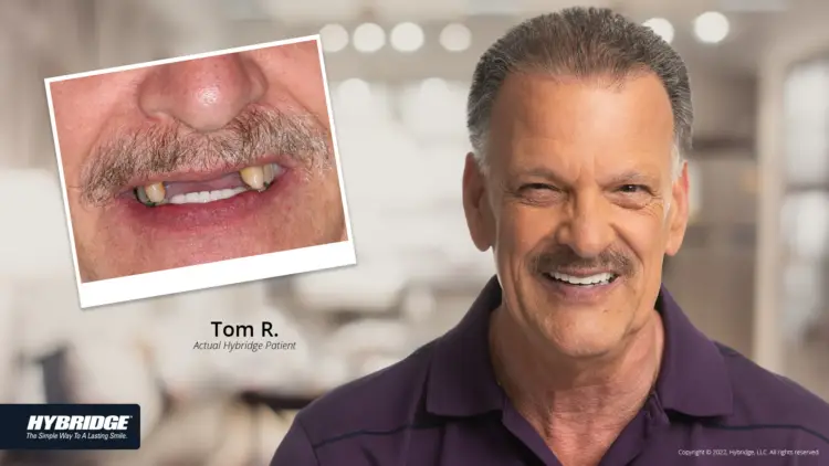 hybridge before and after smile
