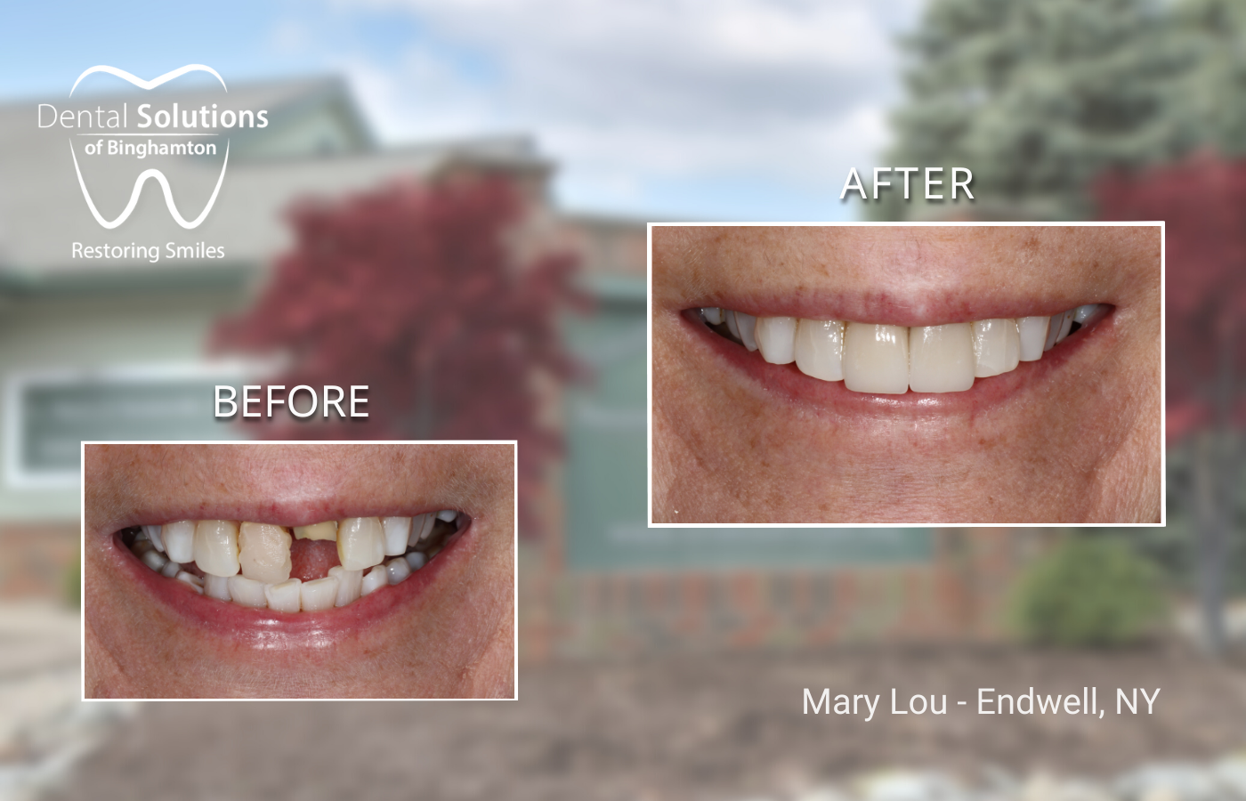 Restorative Dentistry Crowns, missing tooth, Vestal, NY