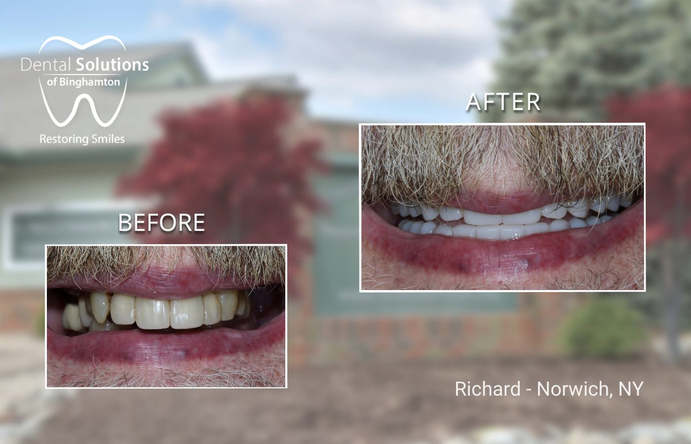 Hybridge Implants